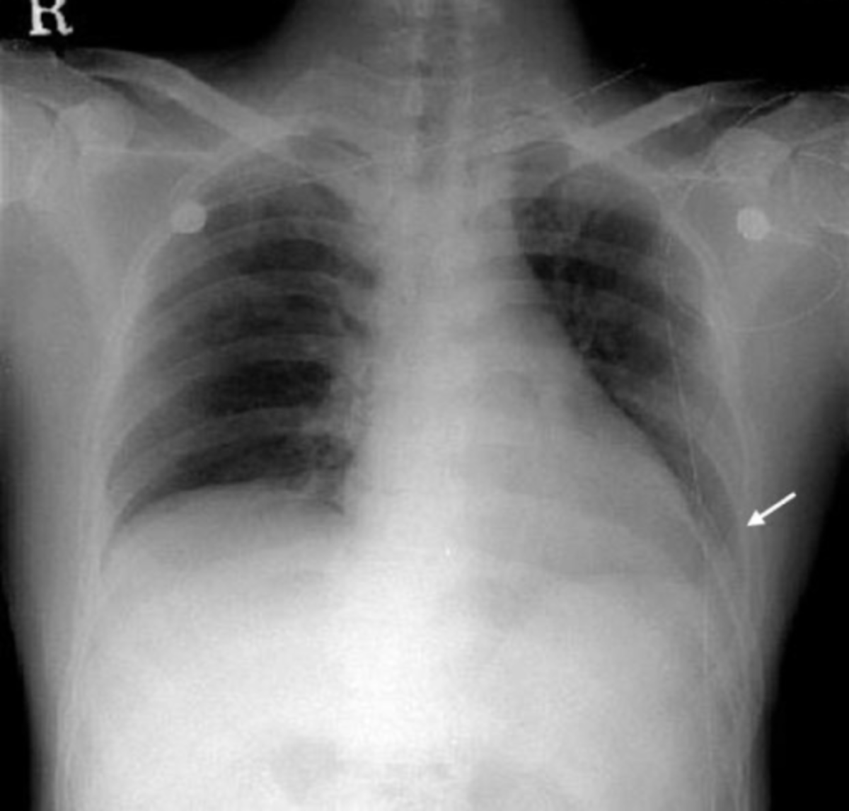 Different Radiographs To Depict And Show Pleural Effusion In Affected