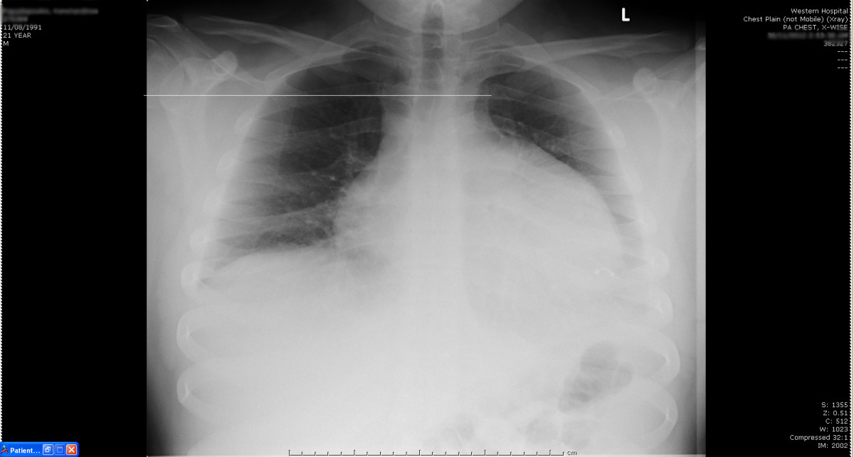Different Radiographs To Depict And Show Pleural Effusion In Affected