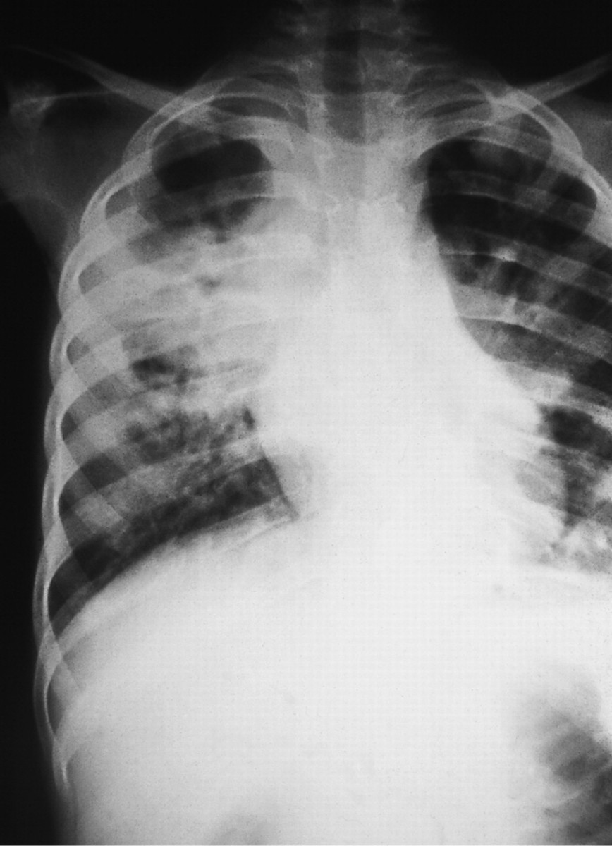 Pneumonia Manifestation Seen And Diagnosed Via XRays Different