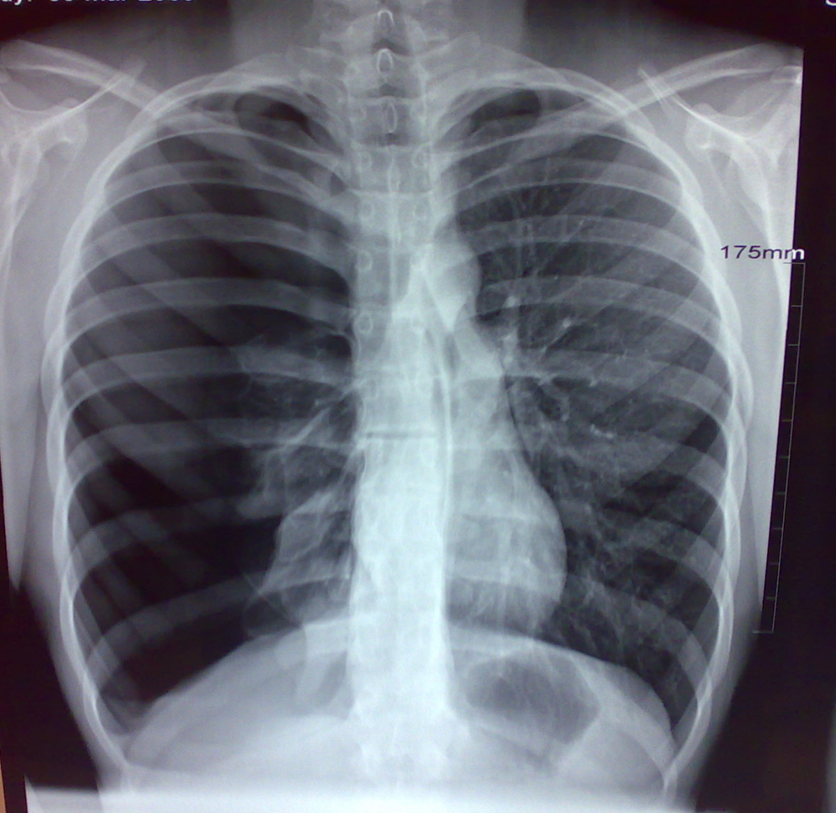 X Ray Diagnostics Of Pneumothorax Radiographic Representations Of The