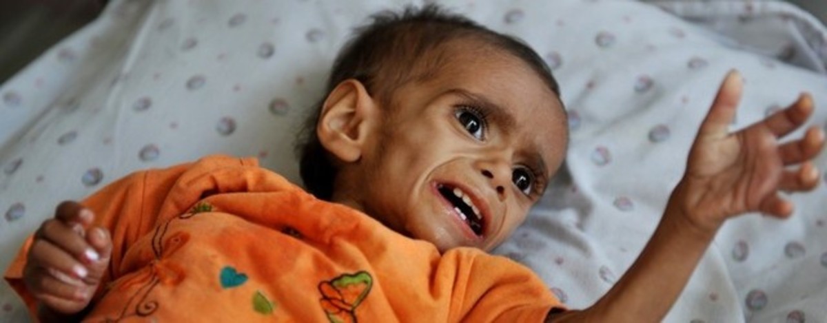 Clinical Manifestations Of Hypothyroidism Cretinism, Myxedema, Hoffman’s Syndrome And Pendred’s