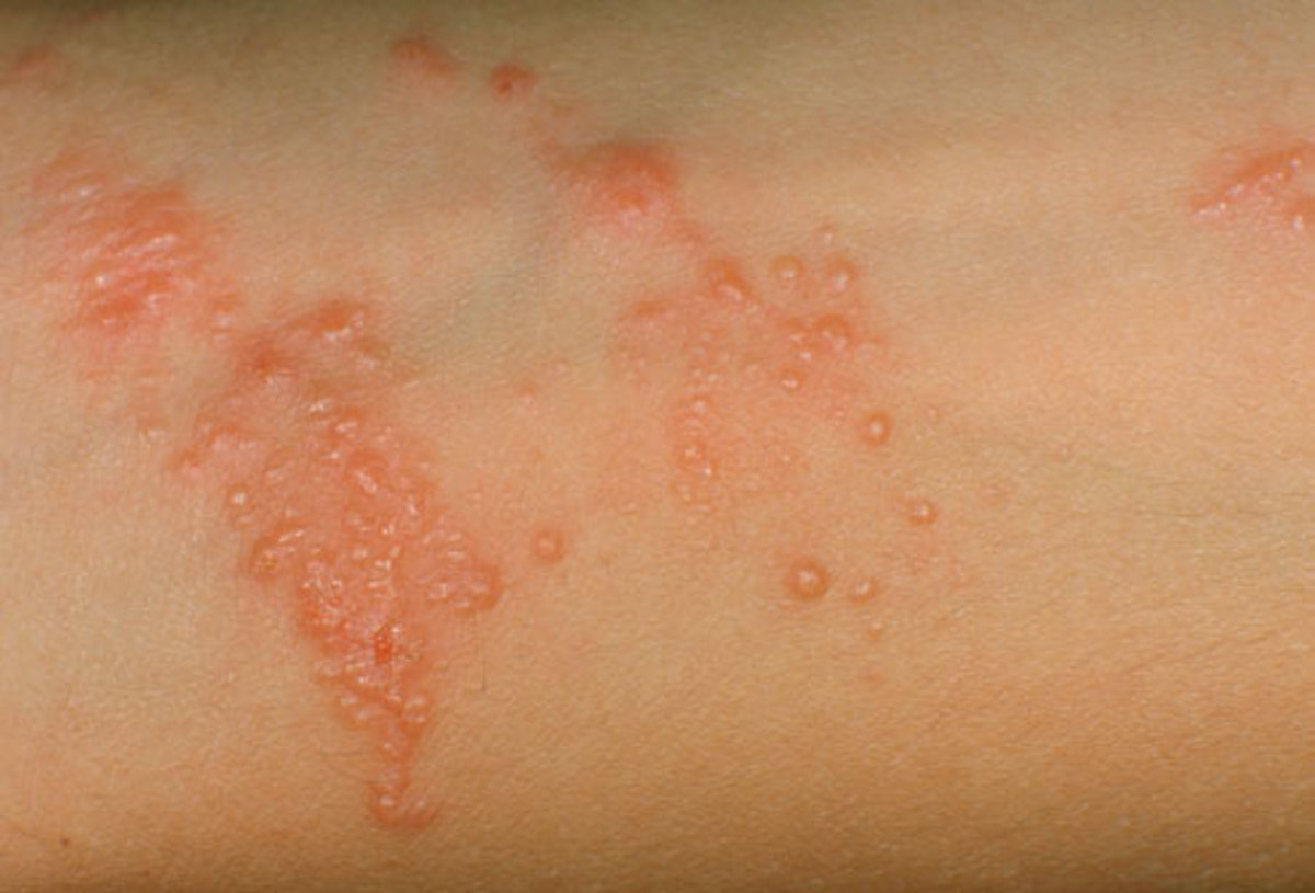 How to Get Rid of Poison Ivy and Poison Oak Rash Healdove