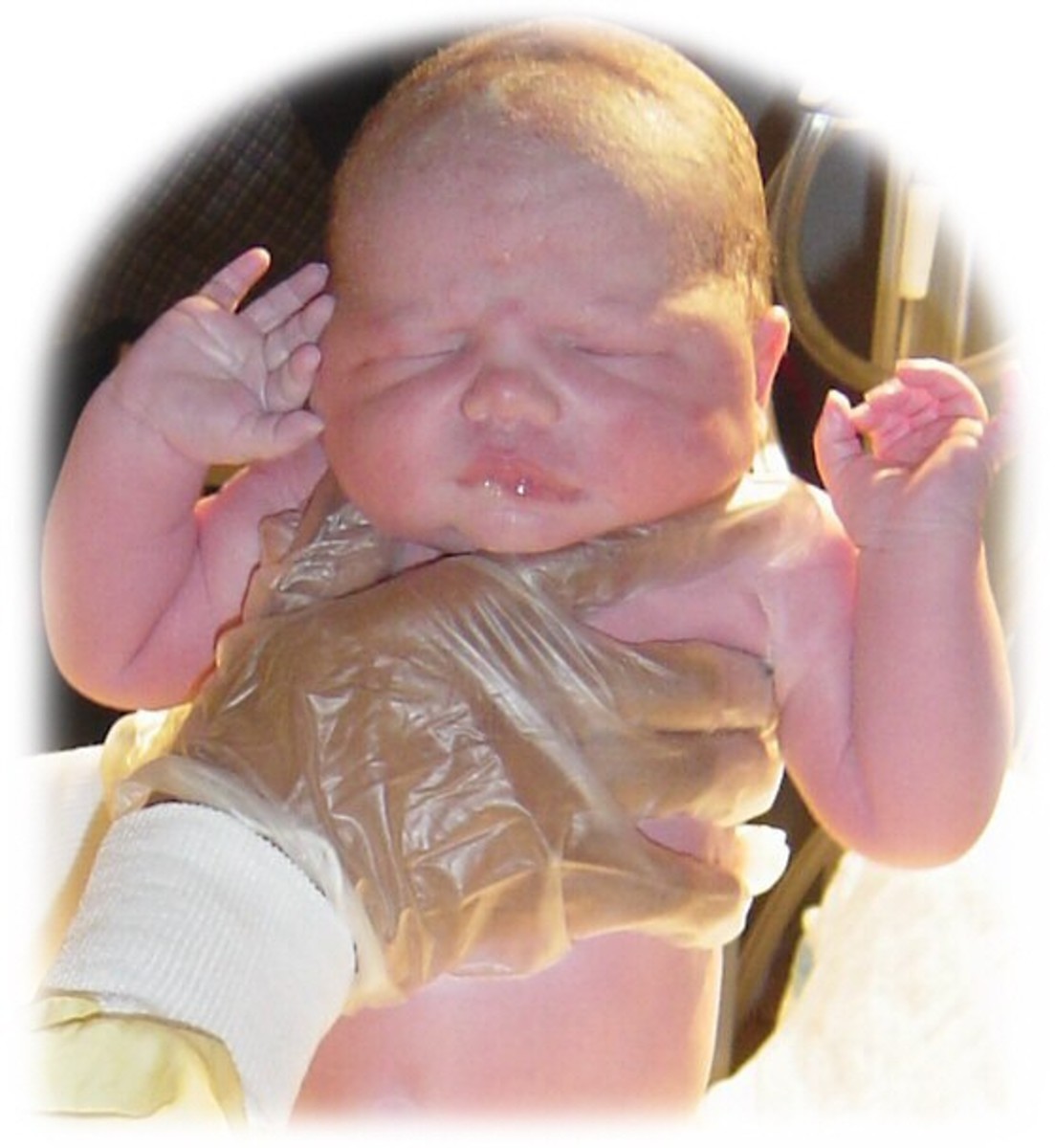 Jaundice Symptoms In Newborns