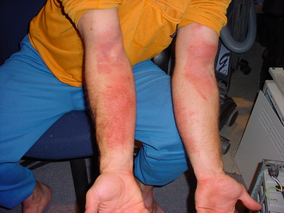 How to Recognize and Prevent Poison Ivy/Oak/Summac Rash and Irritations