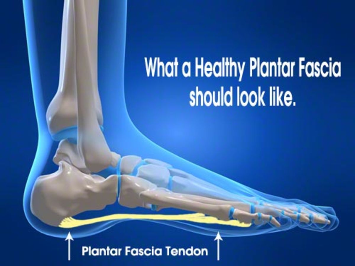 Plantar Fascia Foot Pain, Symptoms, Causes and Treatment