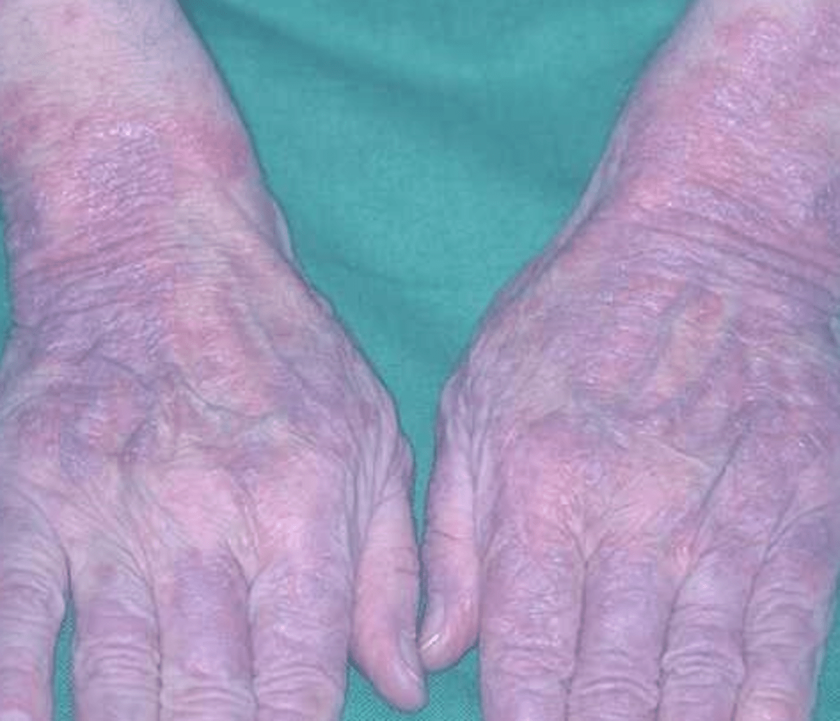 Lupus Rash Pictures, Life Expectancy, Contagious, Symptoms, Treatment