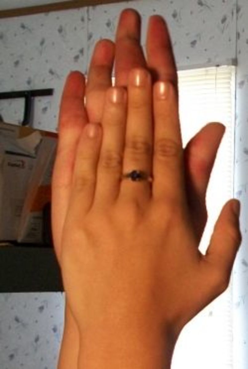 Klippel Trenaunay Weber Syndrome My Story HubPages