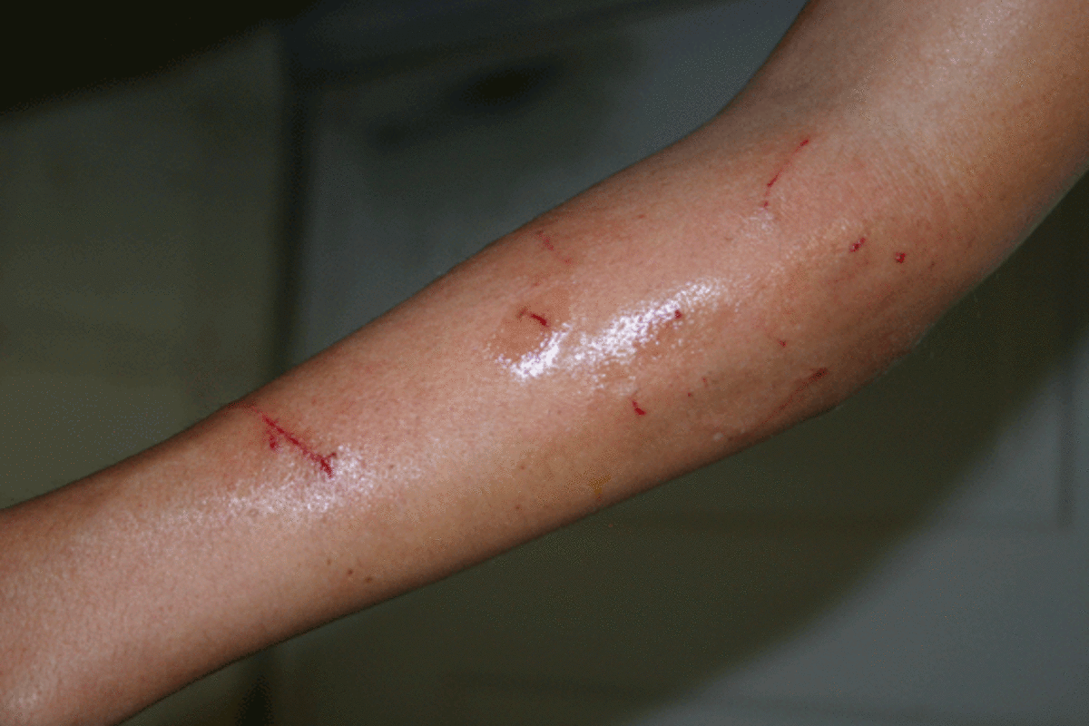 MRSA (staph infections) Warning Signs and Preventive Measures 31014