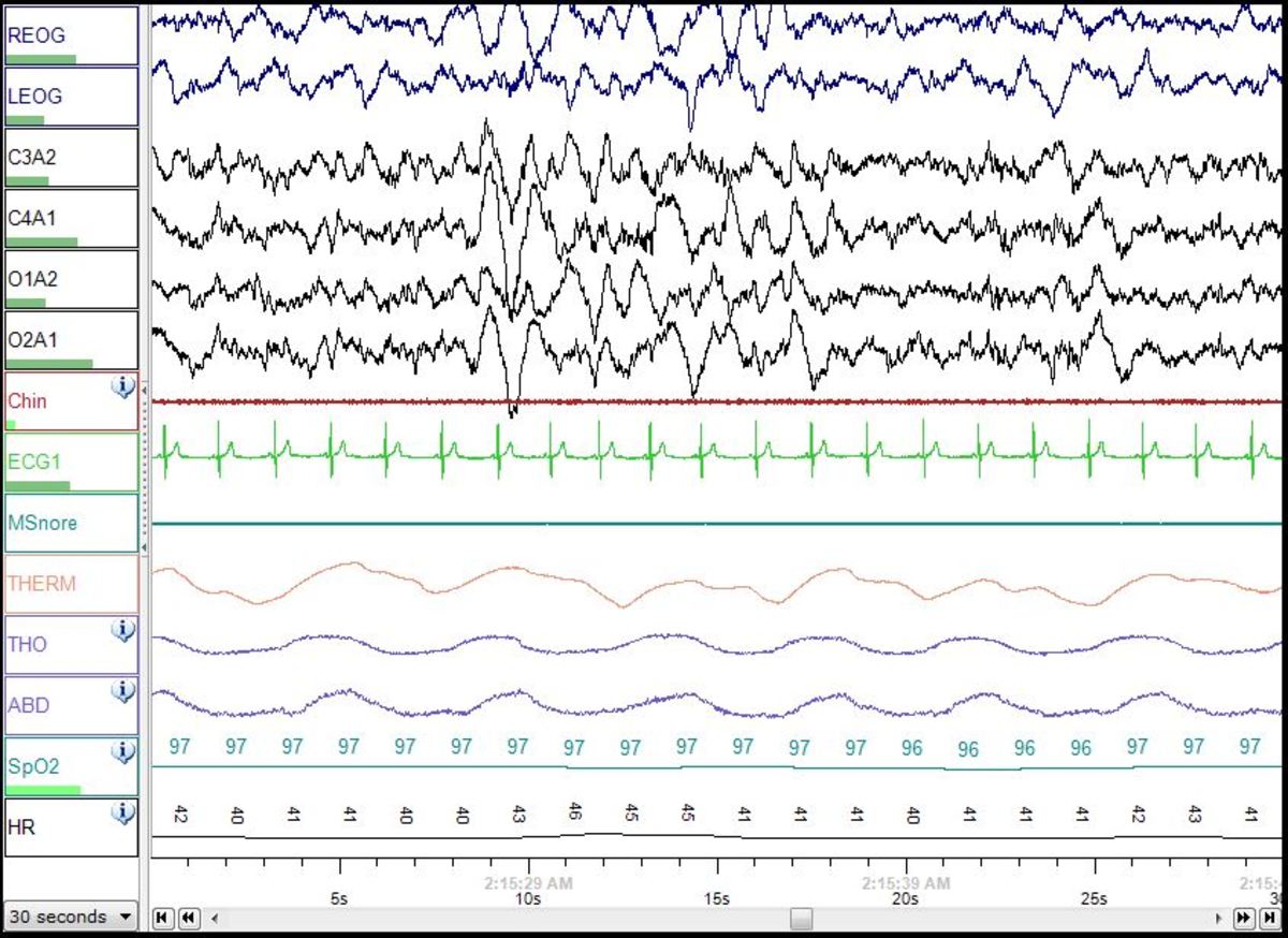 My Sleep Study Experience Overnight Test for Sleep Apnea