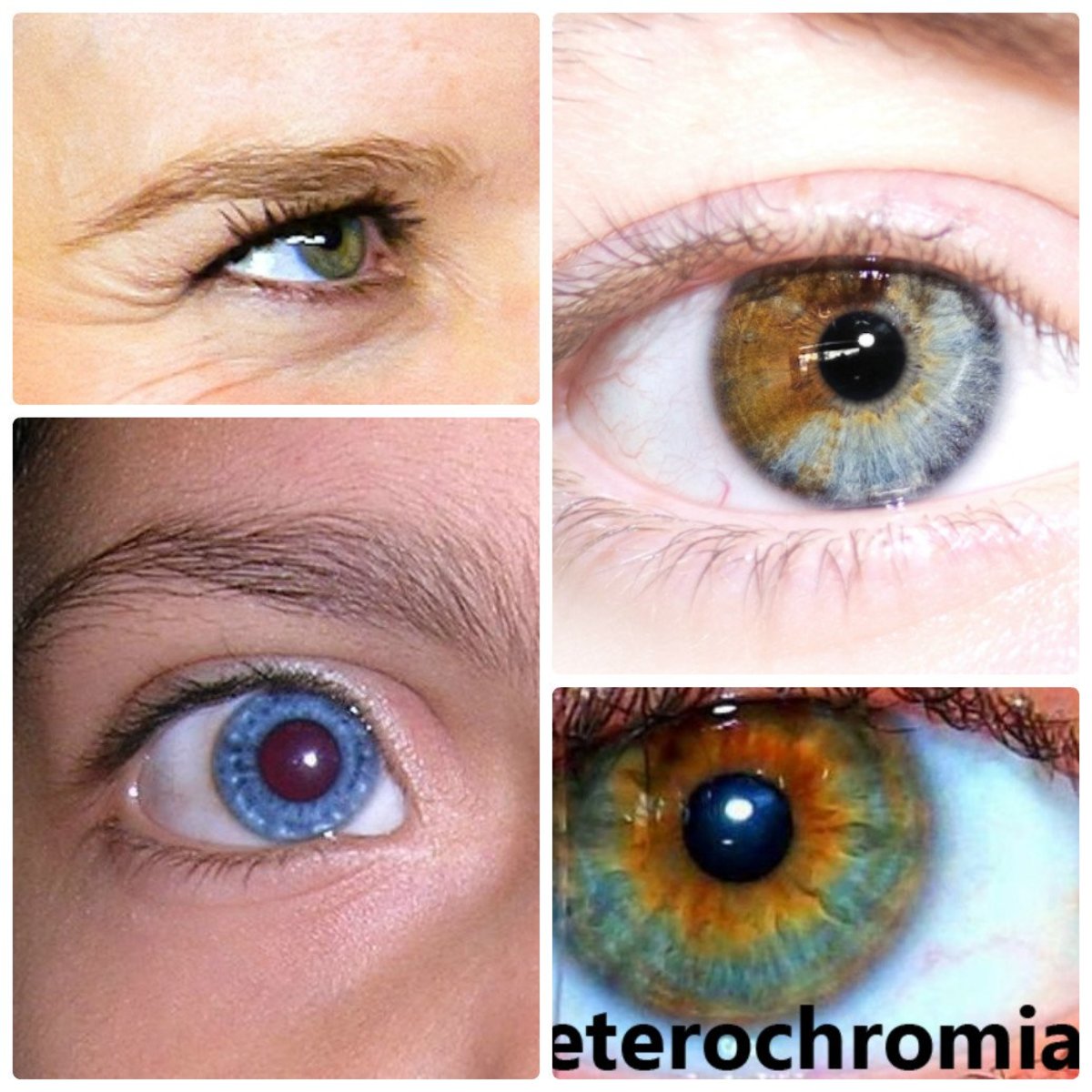 Heterochromia Iridum People with two different colored eyes