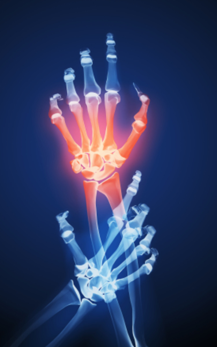 Lupus Survival Guide HealDove