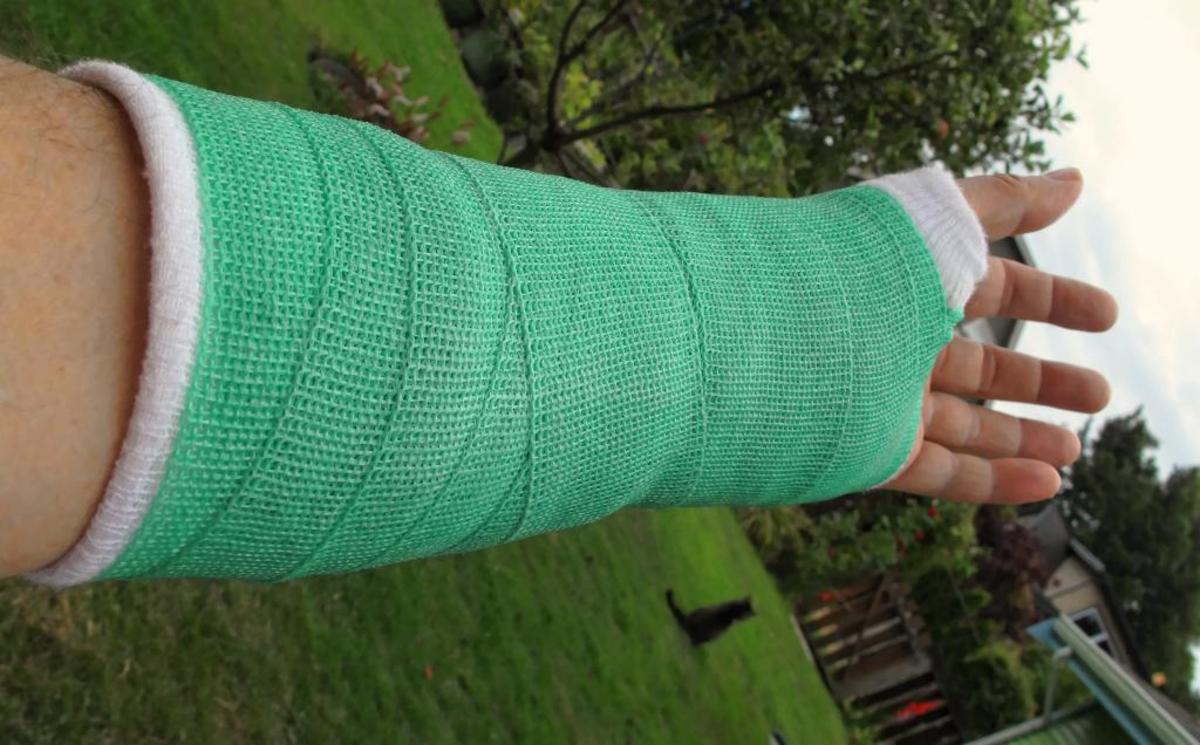 Recovering From Two Broken Wrists My Story HealDove