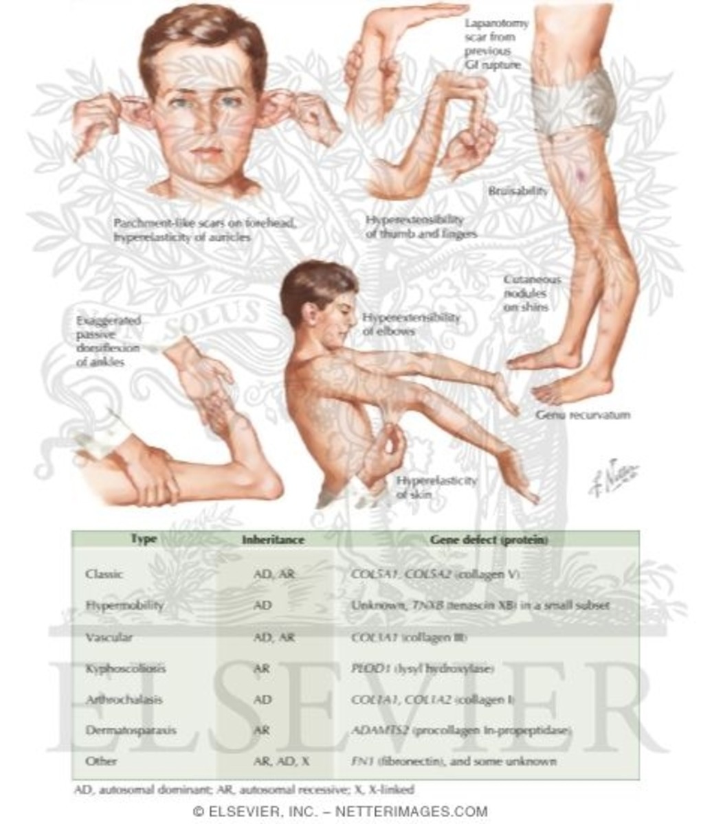The Four Main Forms of EhlersDanlos Syndrome hubpages