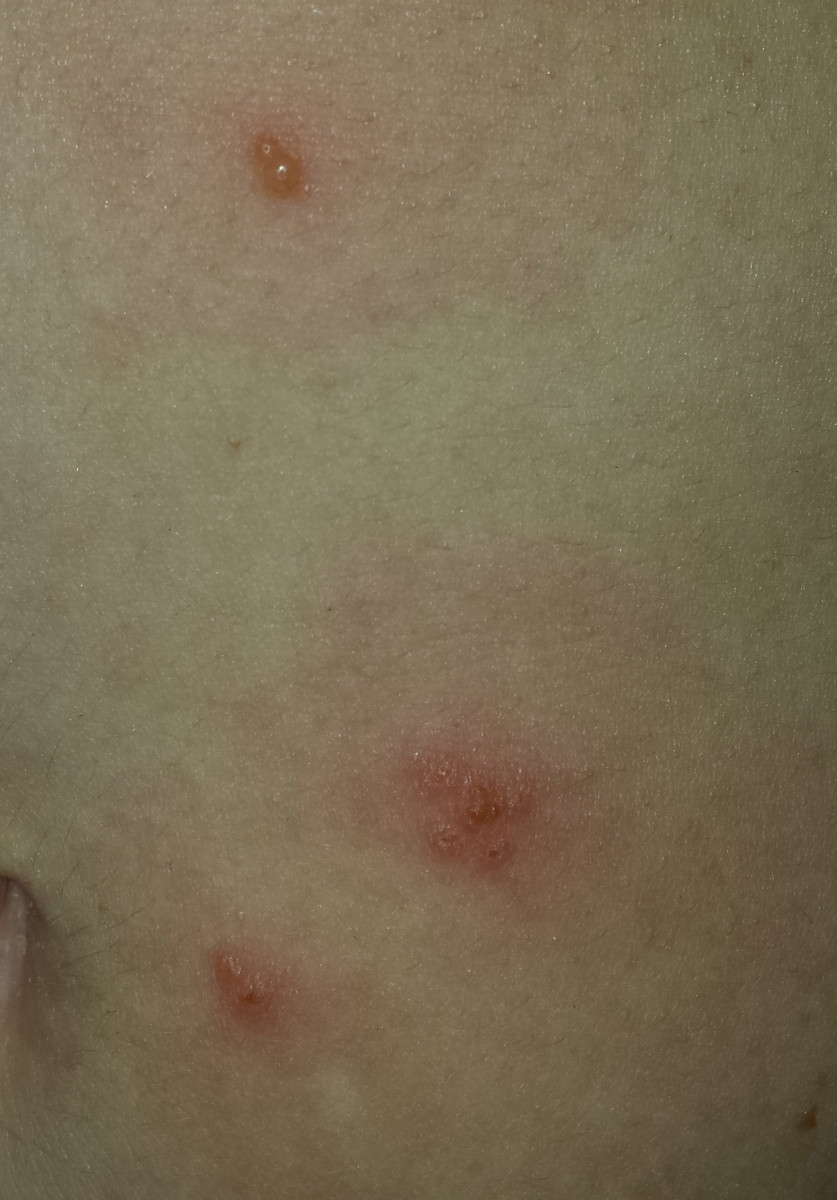 Shingles Varicella Zoster Strikes Again!