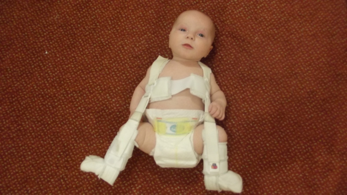 Hip Dysplasia 'Clicky Hips' in Babies HubPages