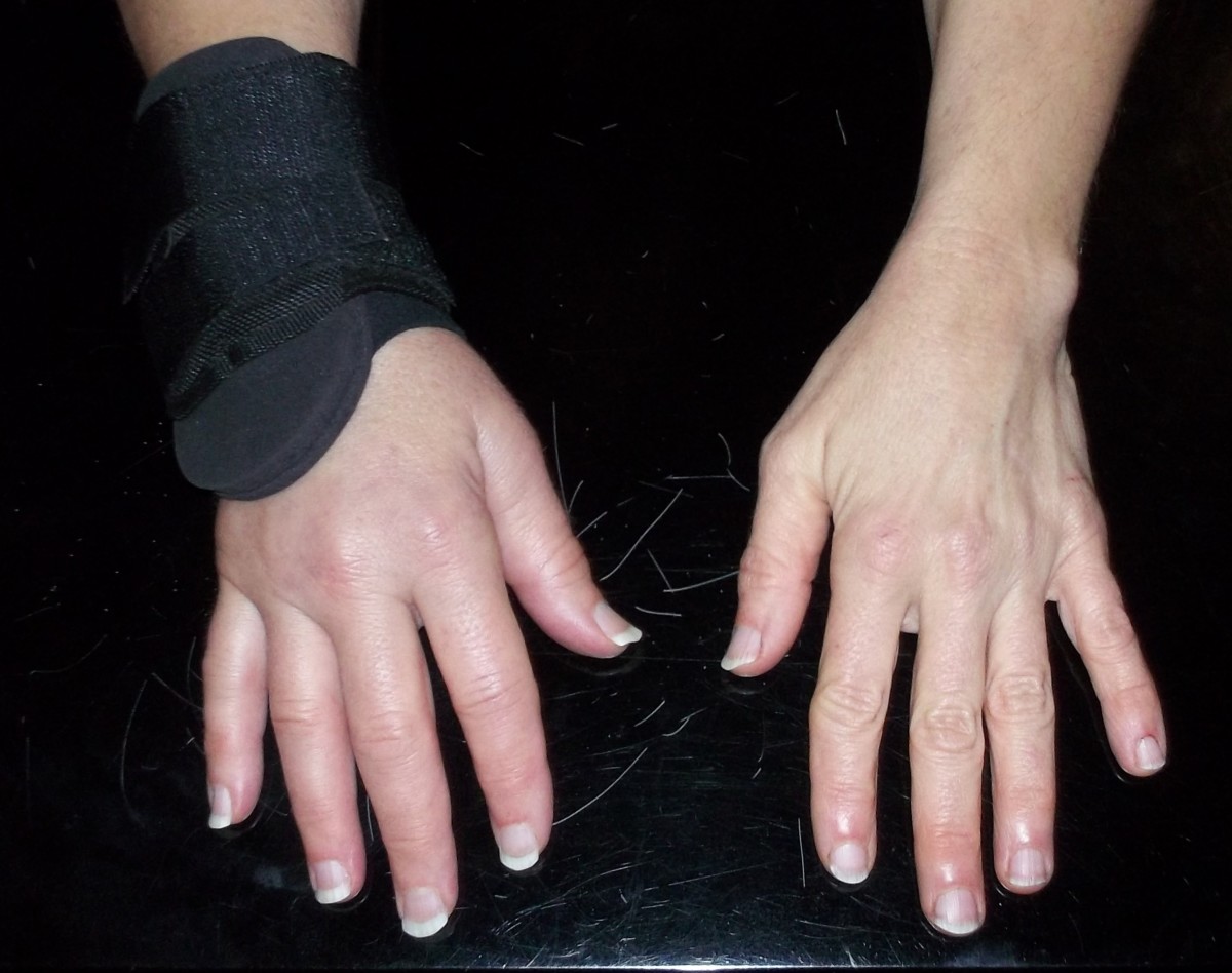 My Broken Wrist Experience YouMeMindBody