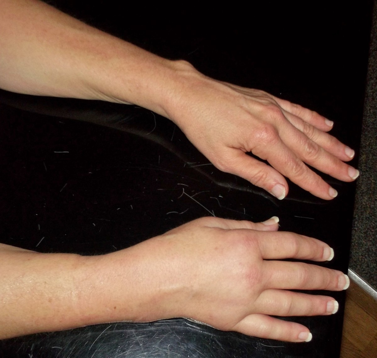 DIY Physical Therapy Ideas for My Broken Wrist HubPages