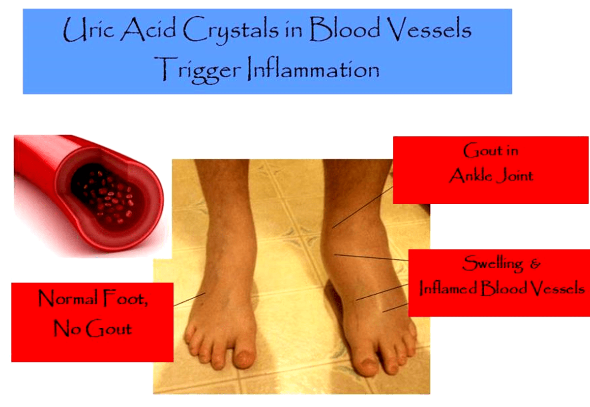 Everything You Ever Wanted to Know About Gout Causes, Symptoms