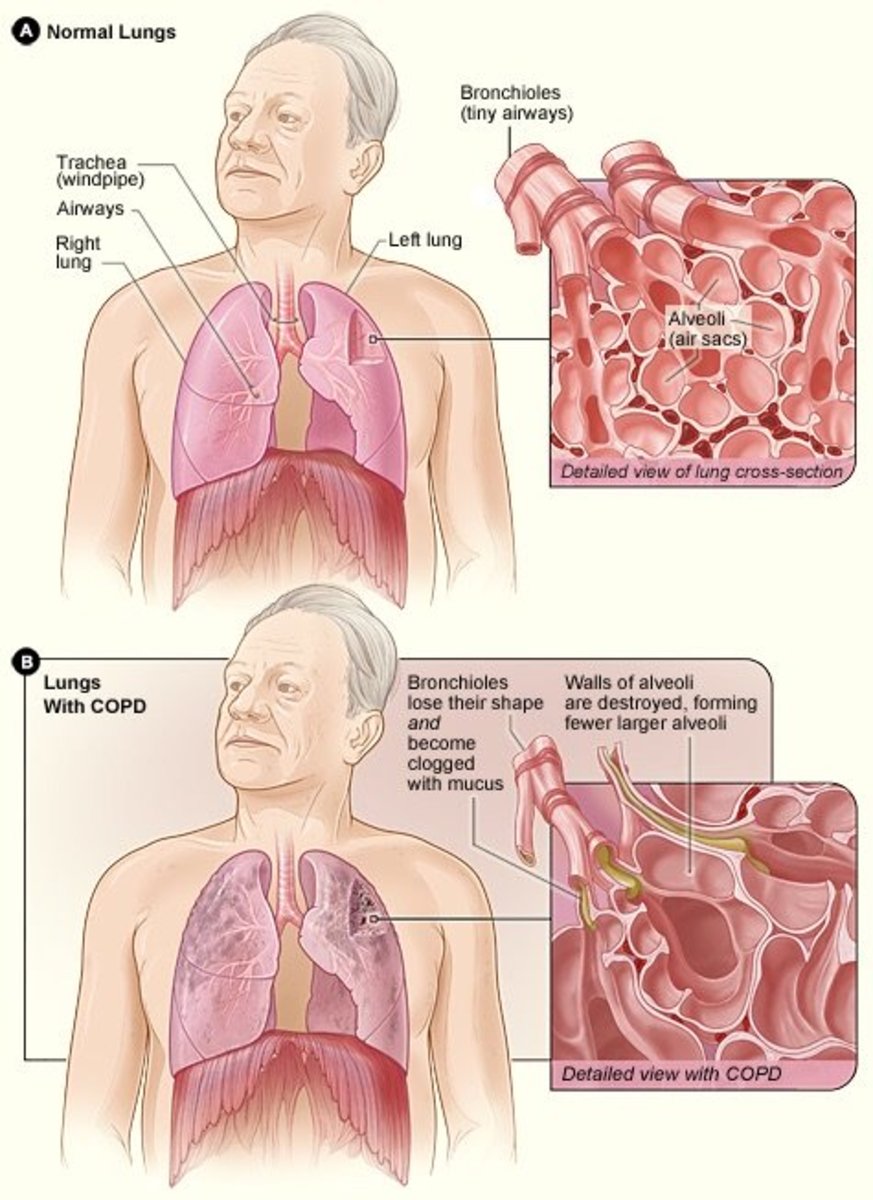 Copd Oxygen And Carbon Dioxide Perokok r