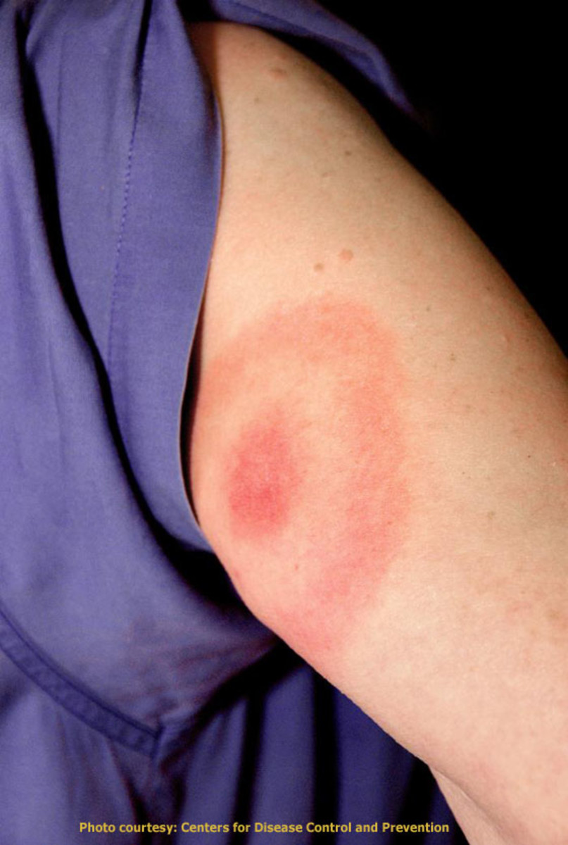 Bullseye Rashes Ringworm and Lyme Disease Differences HealDove