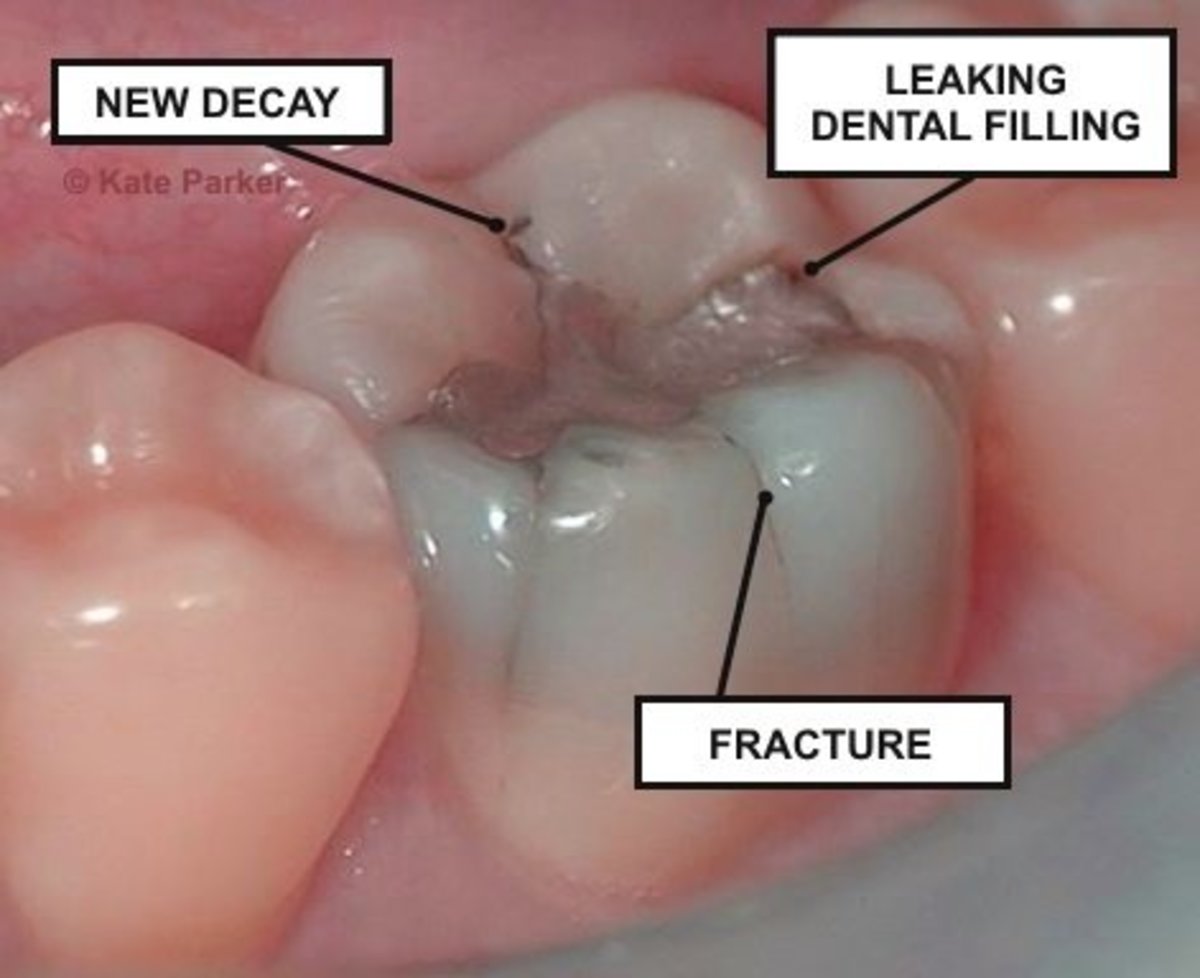Natural Tooth Pain Remedies RemedyGrove