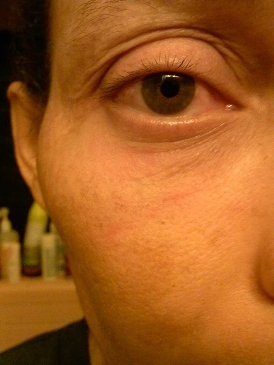 Facing The Lupus Giant My Lupus Diagnosis HubPages