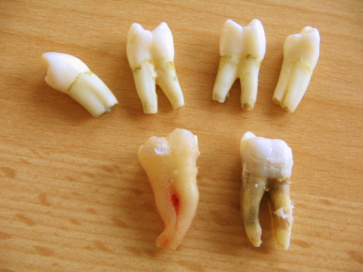 How to Stop Wisdom Tooth Pain (Until You Can Get to the