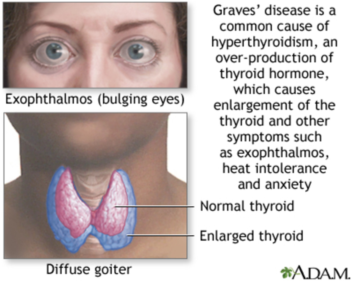 Thyroid Issues Cause Graves Disease HubPages