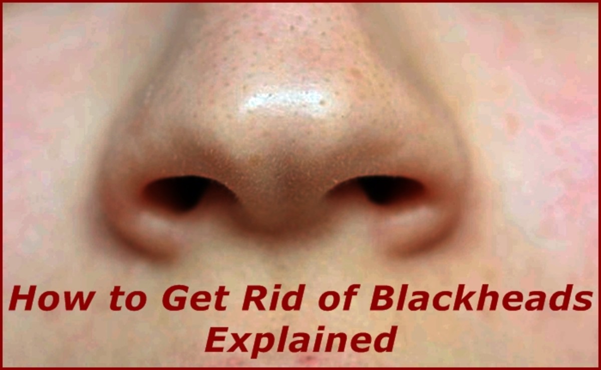 How to Get Rid of Blackheads Explained Bellatory