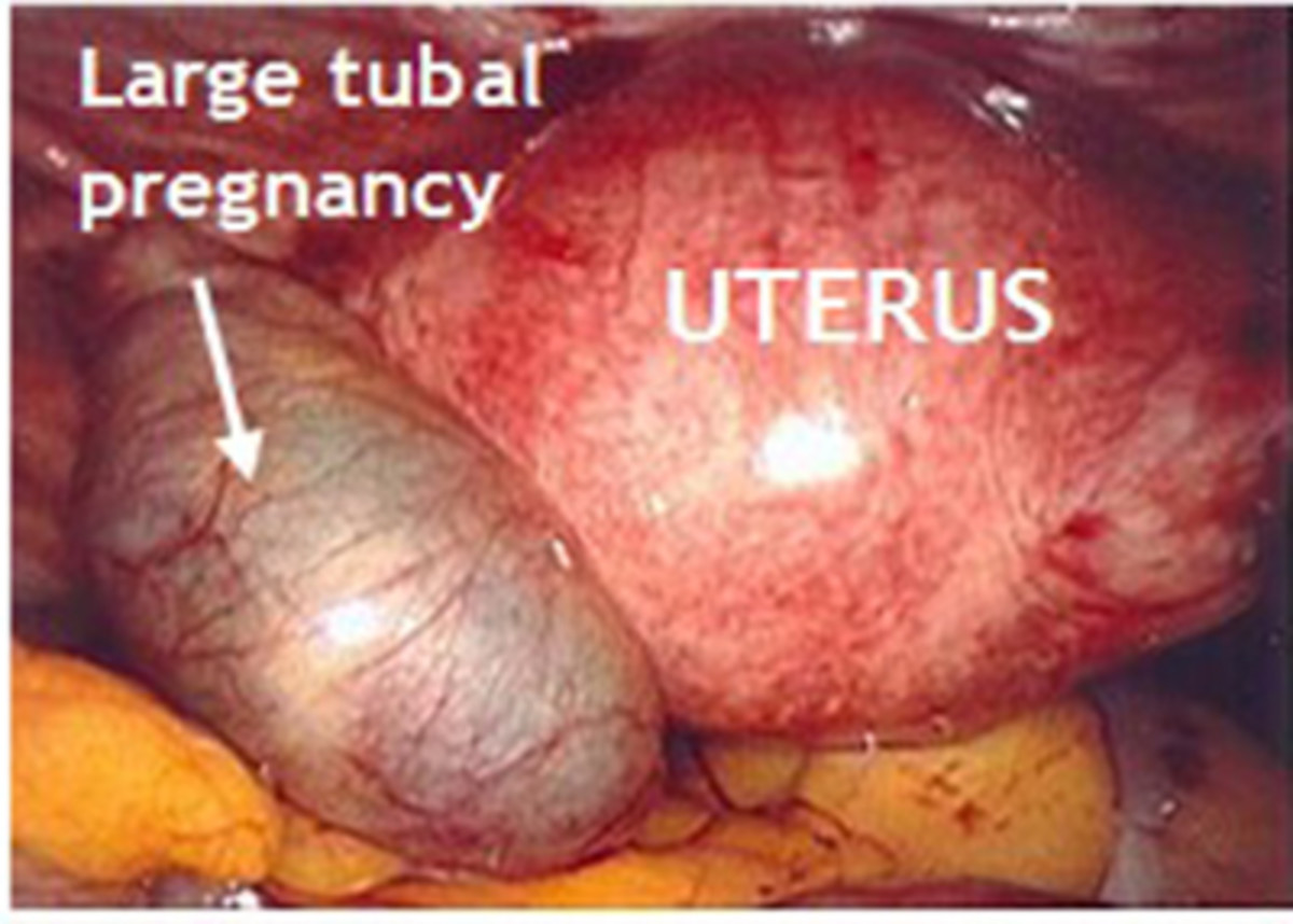 Pregnancy Related Complications Explained HubPages