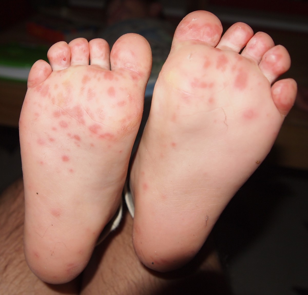 Natural Remedy for Hand, Foot, and Mouth Disease RemedyGrove