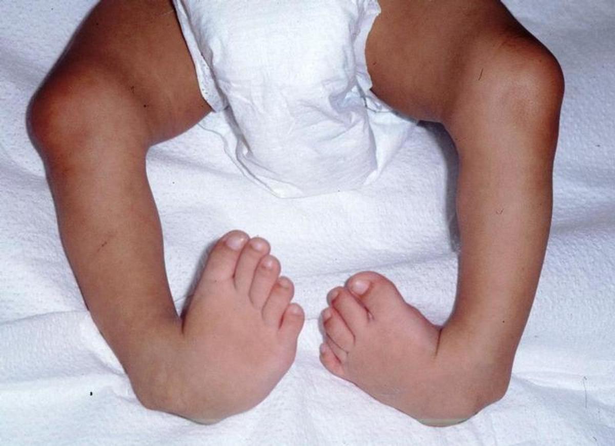 Ten Congenital Problems of the Fetus HubPages