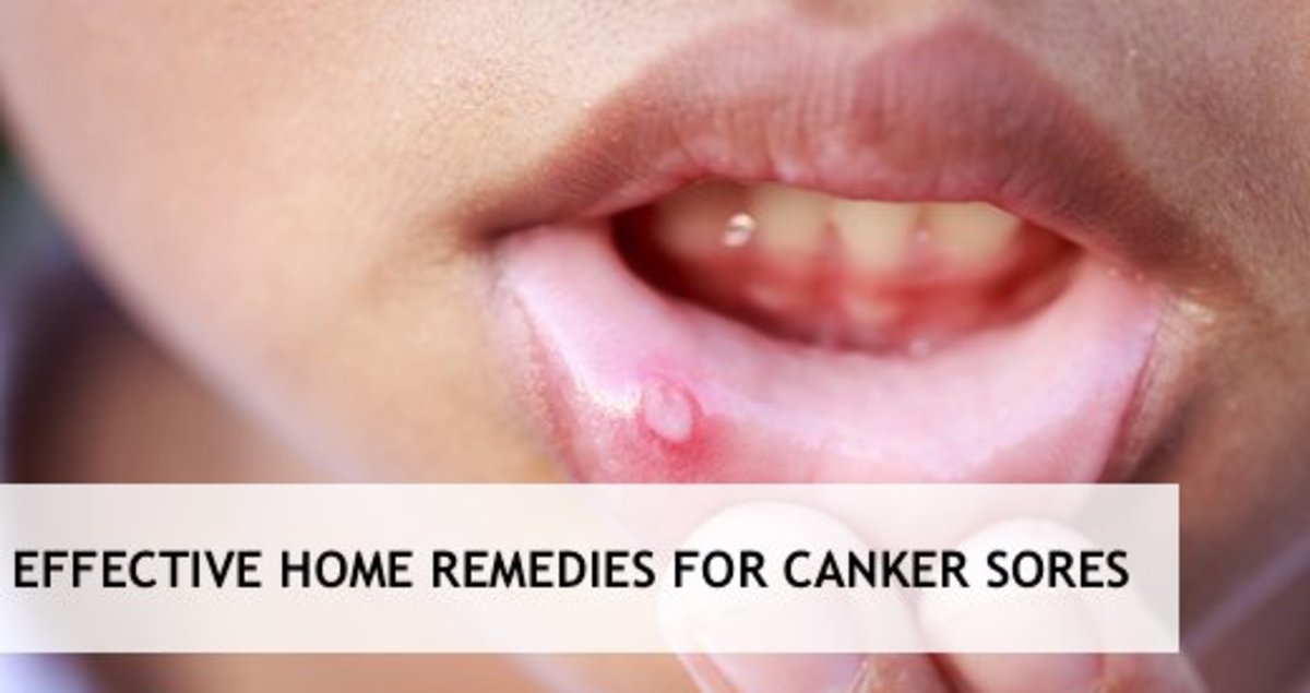 Top 8 Effective Home Remedies for Canker Sores RemedyGrove