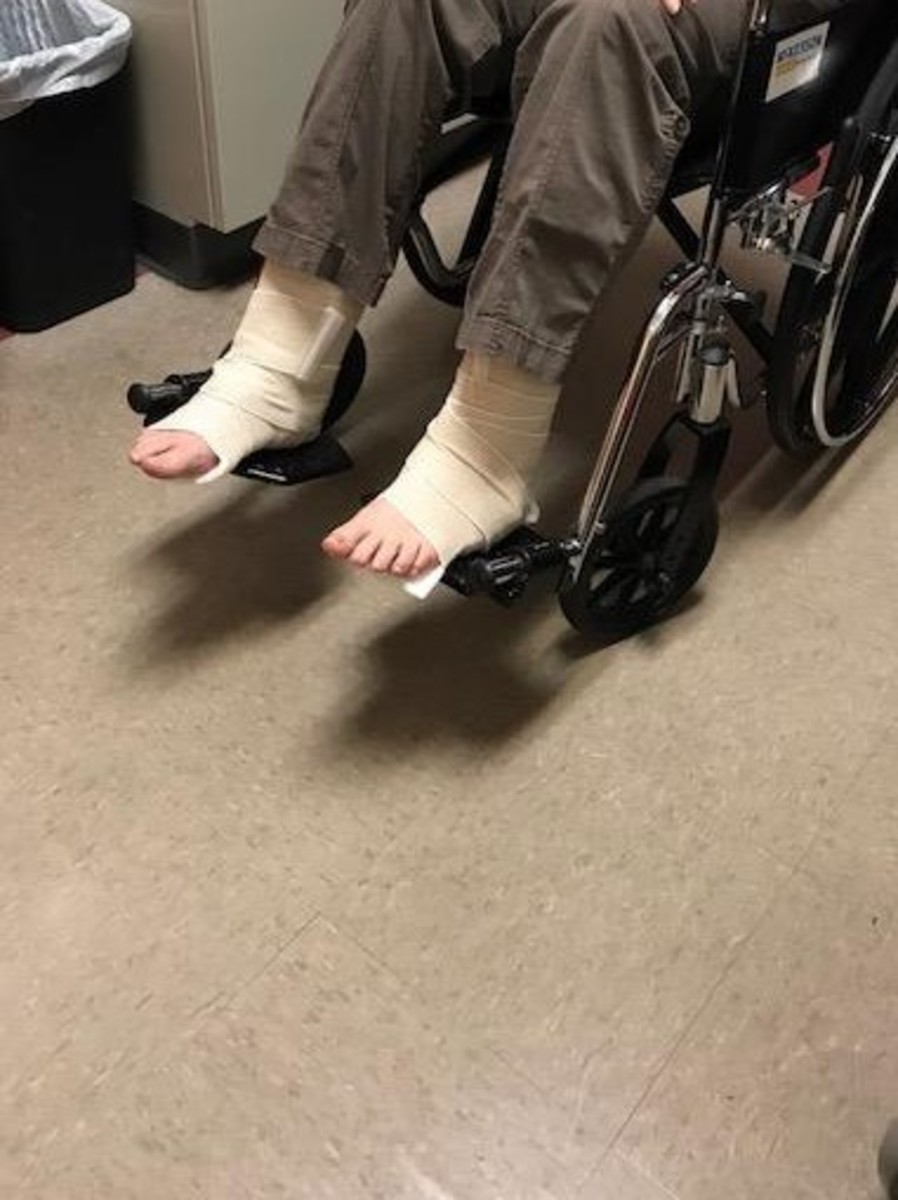 How I Am Recovering From One Broken Ankle and One Sprained Ankle