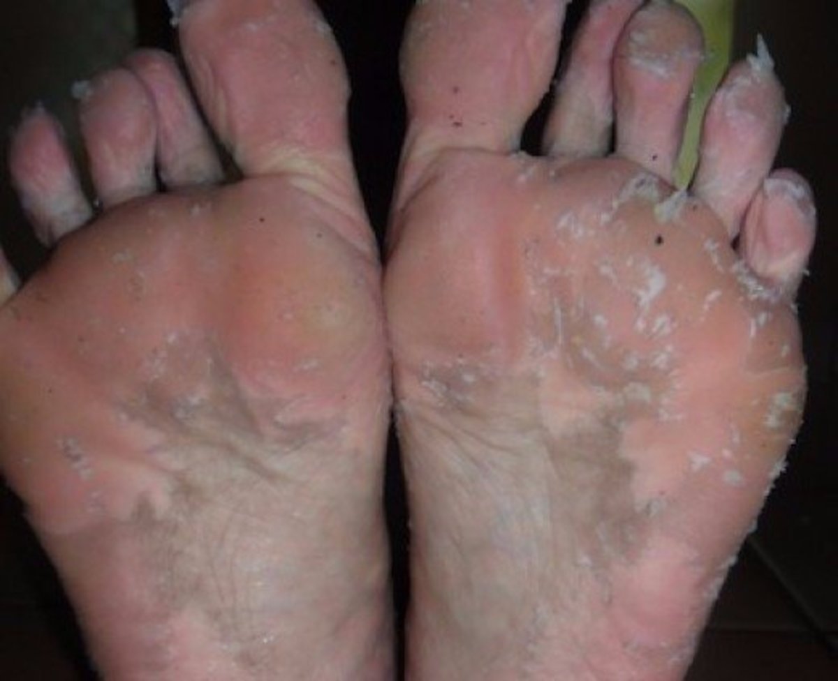 A DIY Peel for Dry, Cracked Feet Bellatory