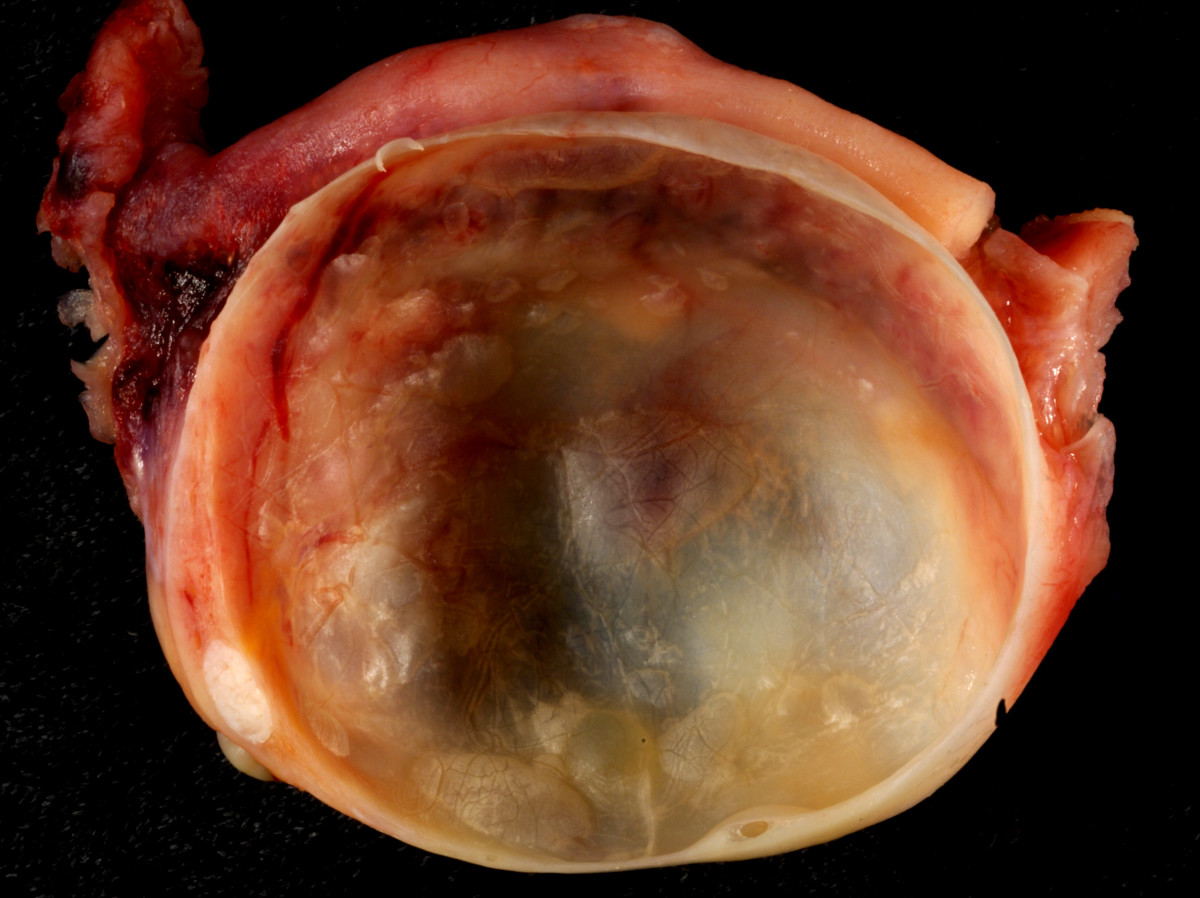 Ovarian Cysts—Causes, Symptoms, and Treatments HubPages