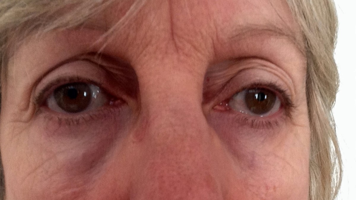 Buy Almond Oil for Under Eye Bags and Dark Circles HubPages