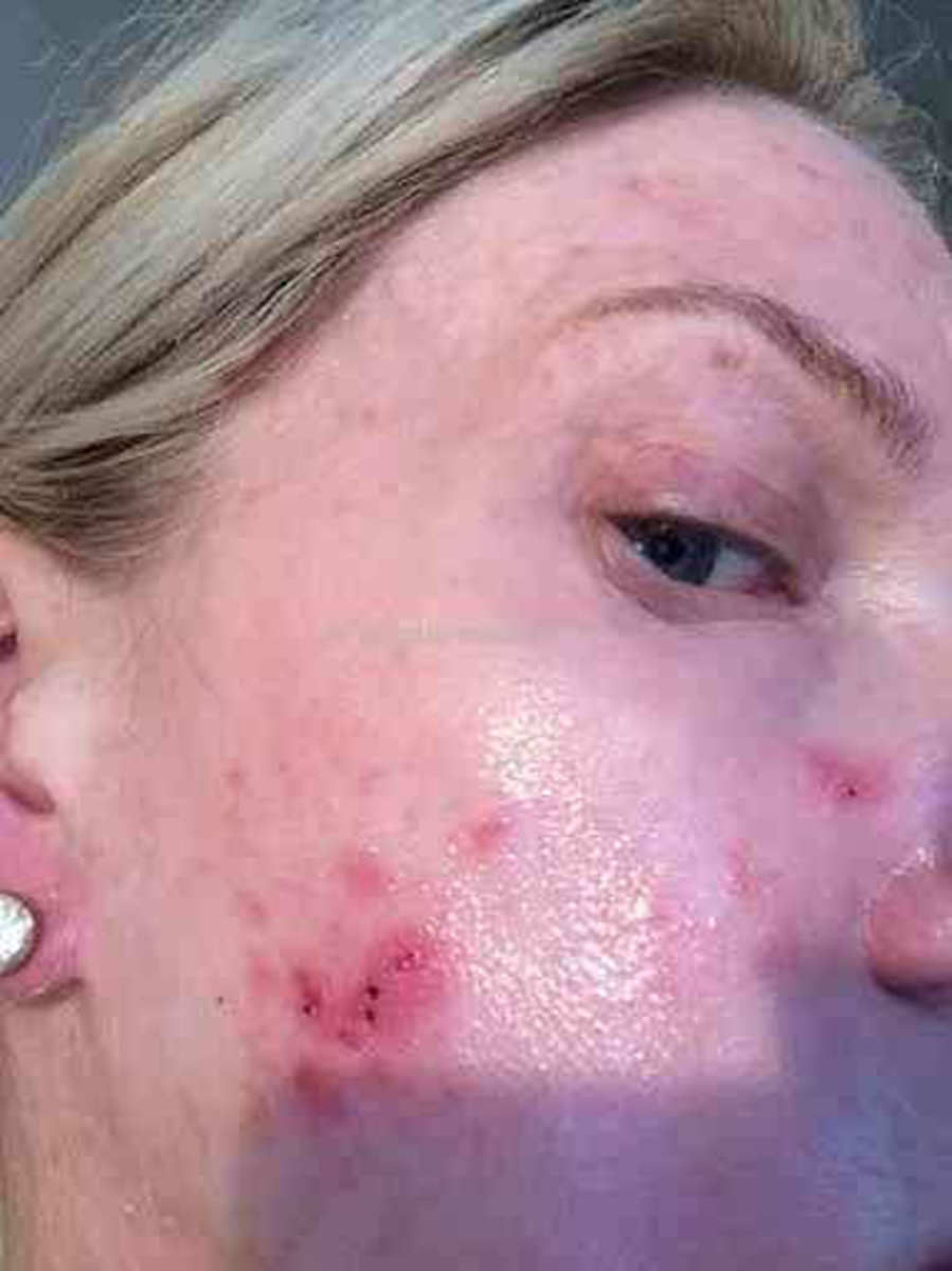 How to Tell the Difference Between Herpes and Pimples (With Photos