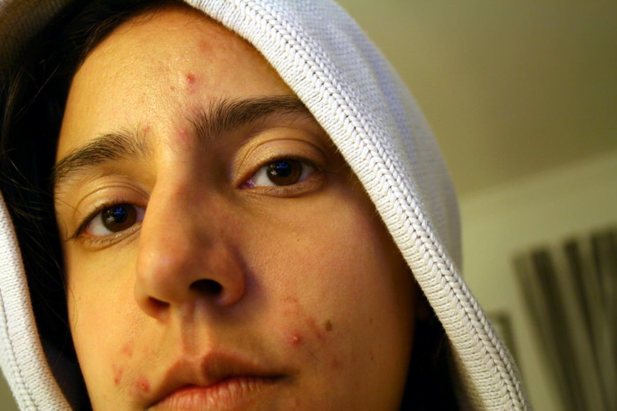 How to Tell the Difference Between Herpes and Pimples (With Photos
