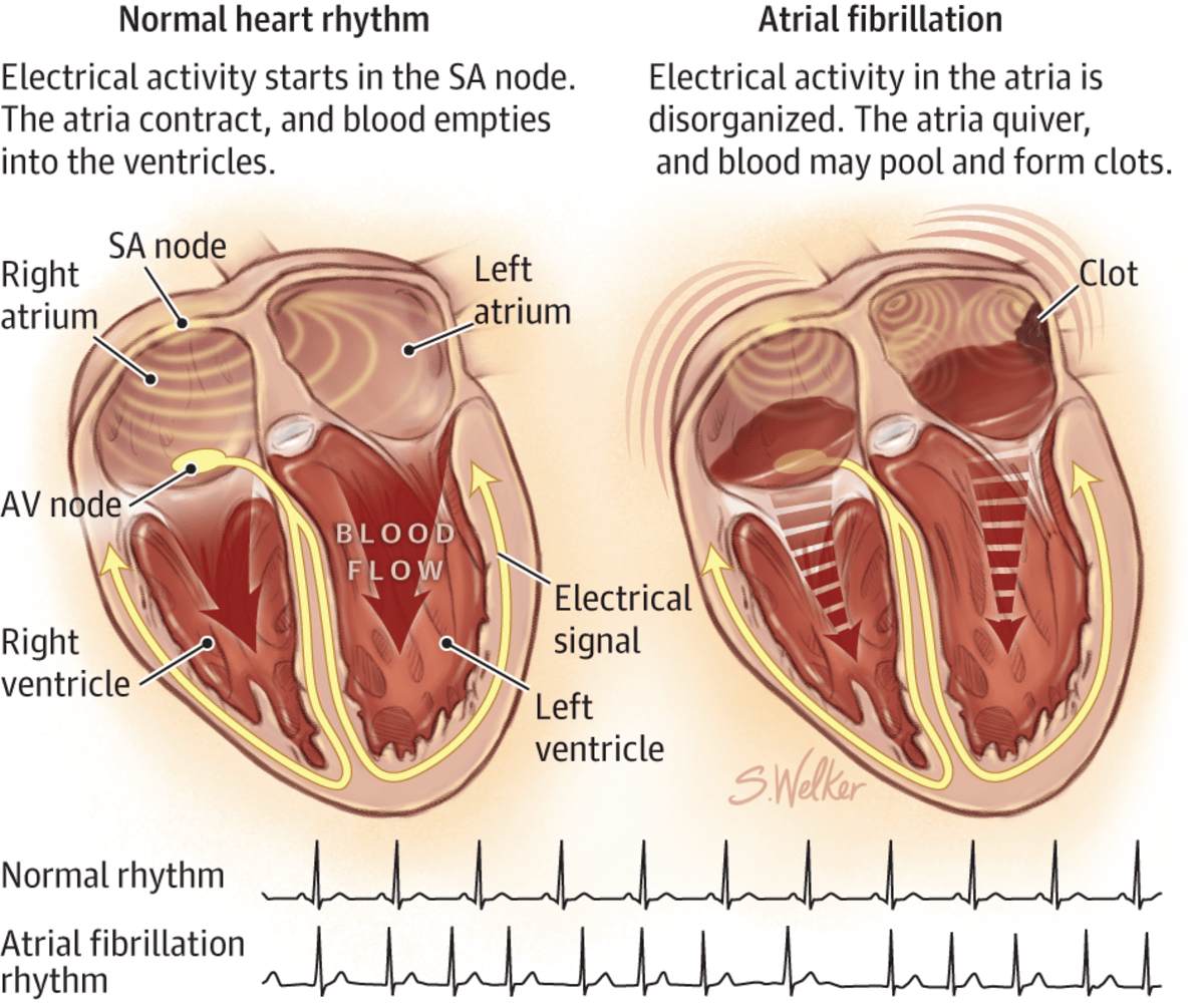 Atrial Fibrillation My Father Is Always Out of Rhythm! Patient's Lounge