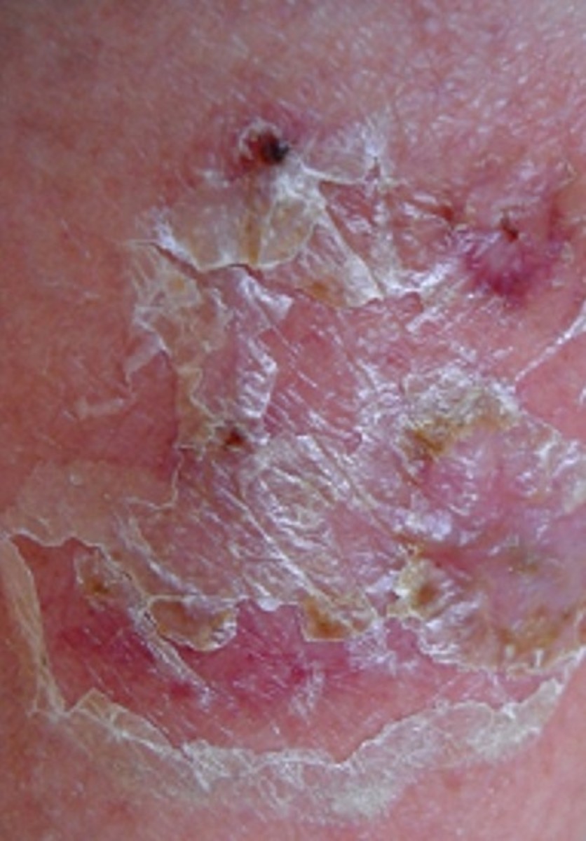 What to Do About Diaper Rash (Nappy Rash) HealDove