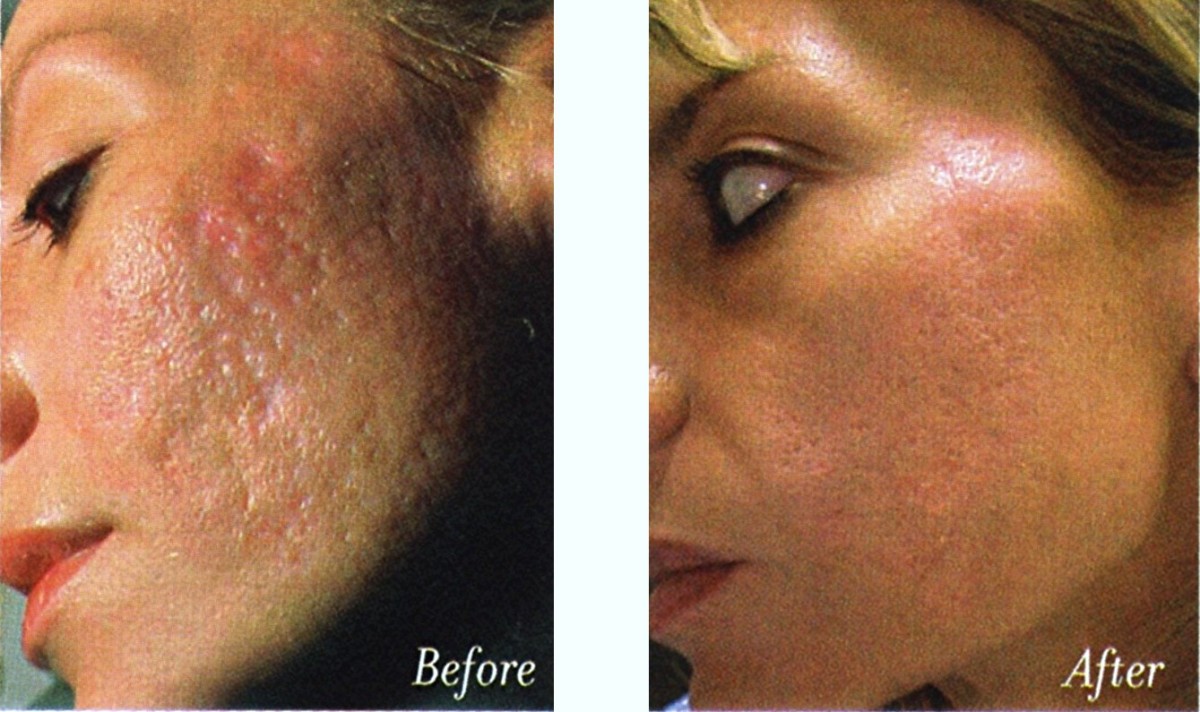 Use TCA To Remove Acne Scars hubpages