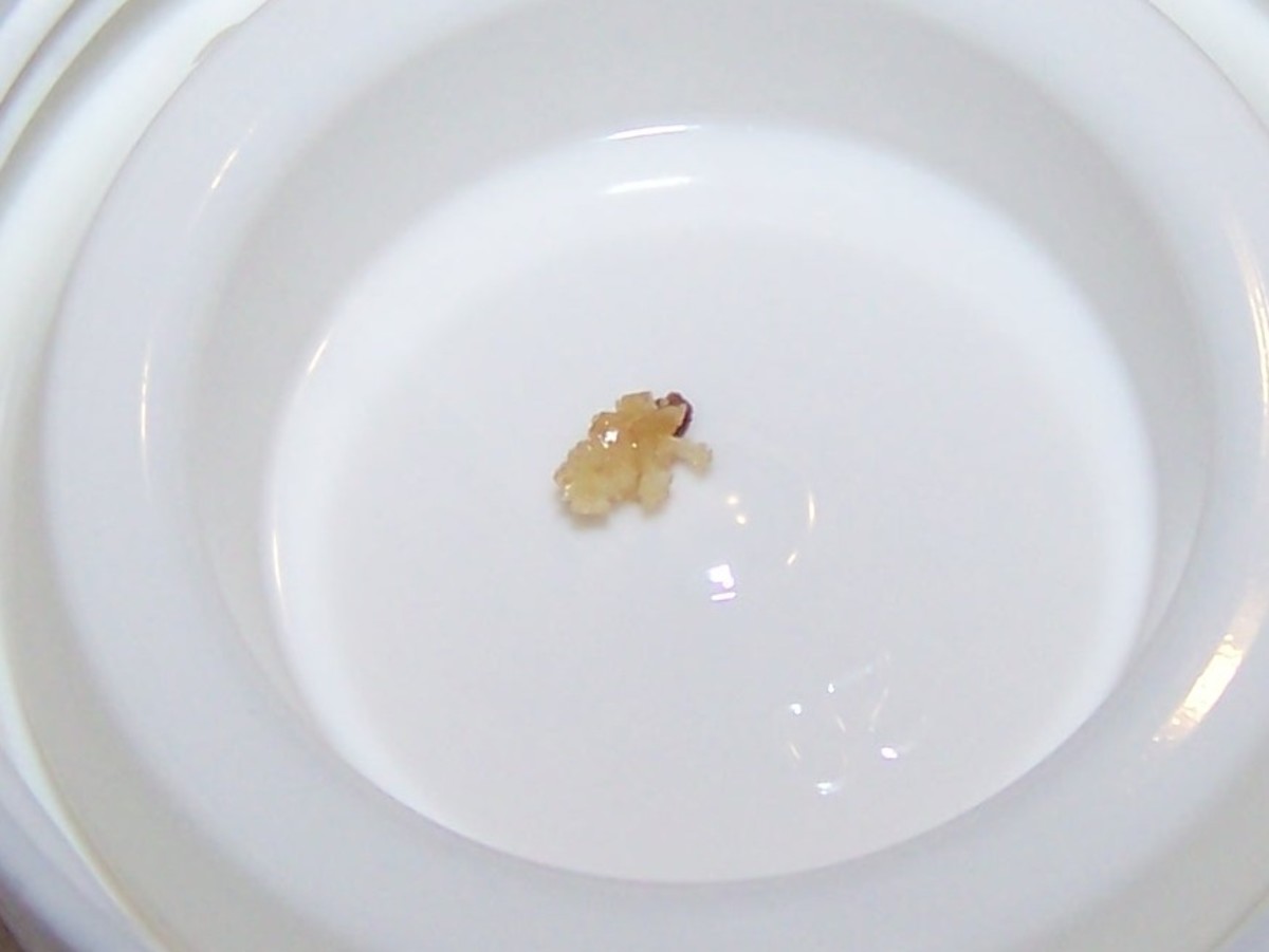 Recognize Early Symptoms of Kidney Stones HubPages