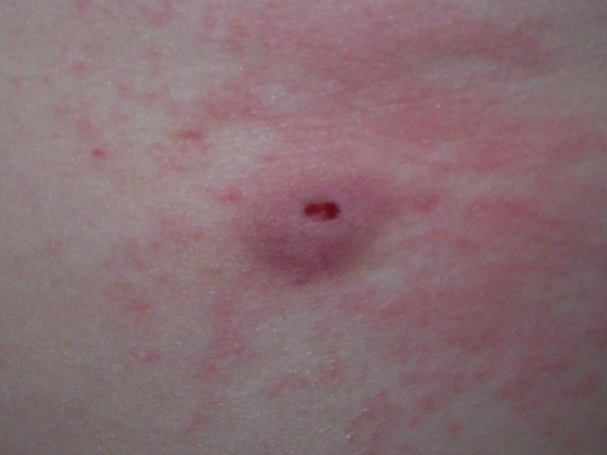 Recognize Early Symptoms of Kidney Stones HubPages