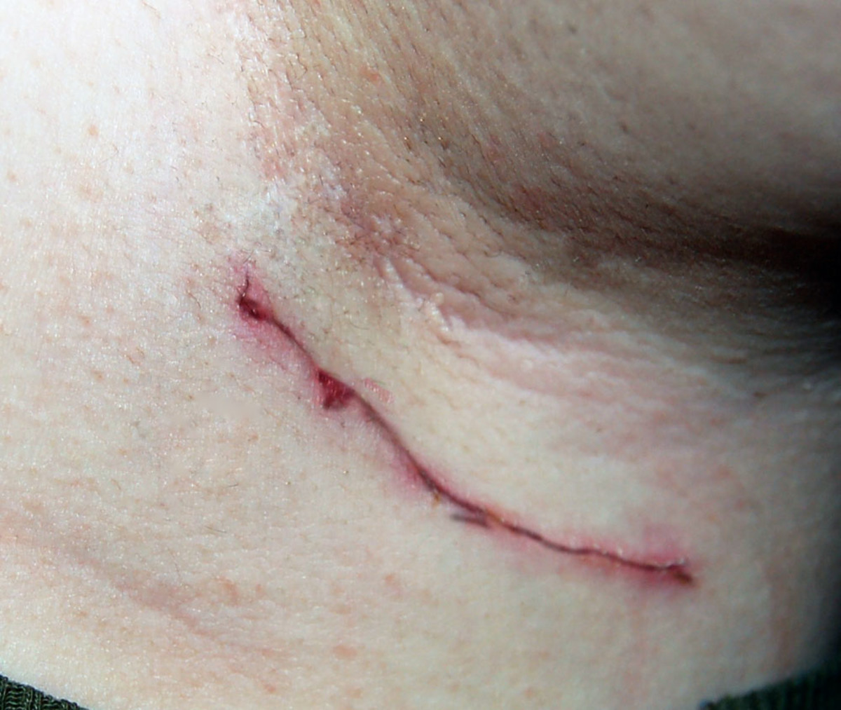 My Journey With Lymphoma Cancer HubPages