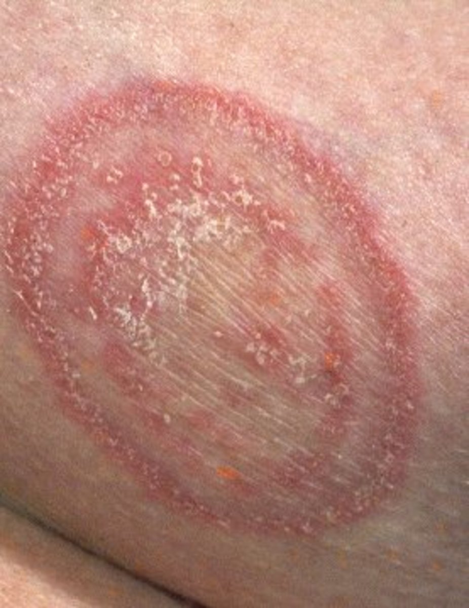 Natural Fungal Infection Treatment With Essential Oils HubPages