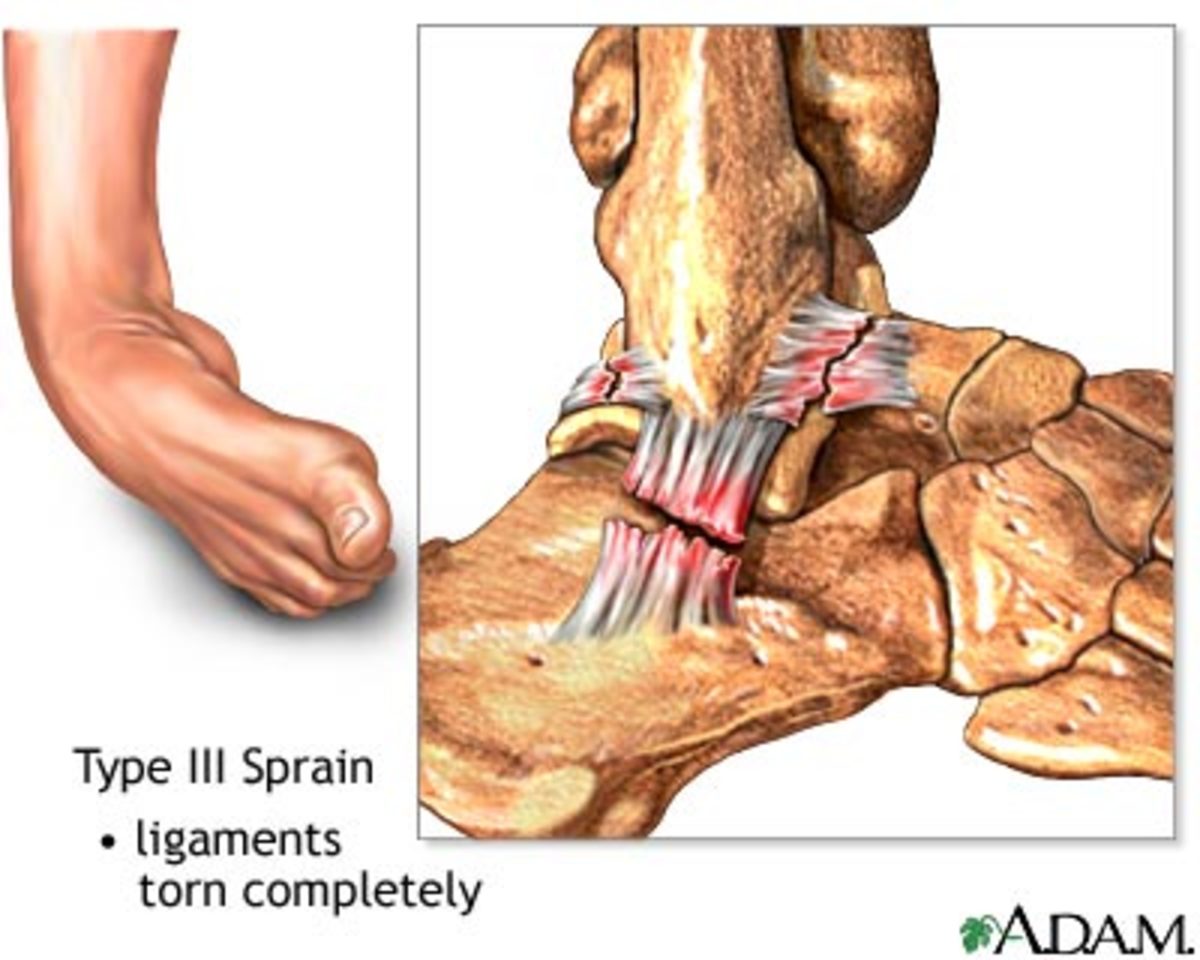 Torn Ligament in my Ankle HubPages
