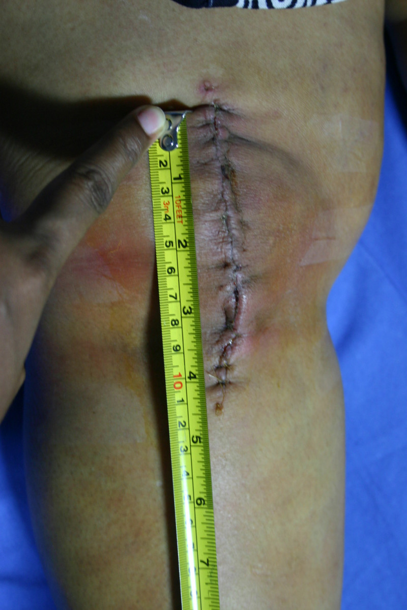 When Is It Time for a Knee Replacement? NNPA