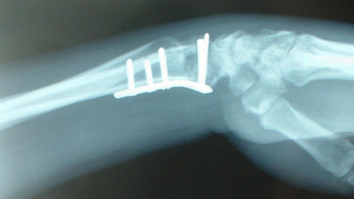 How Long Does A Pinned Wrist Take To Heal at Charles Stinson blog