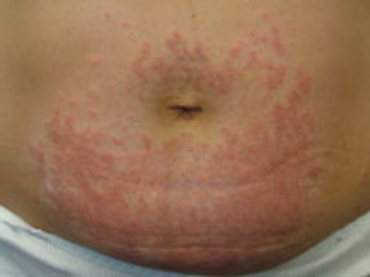 Pregnancy Rash Pruritic urticarial papules and plaques of pregnancy